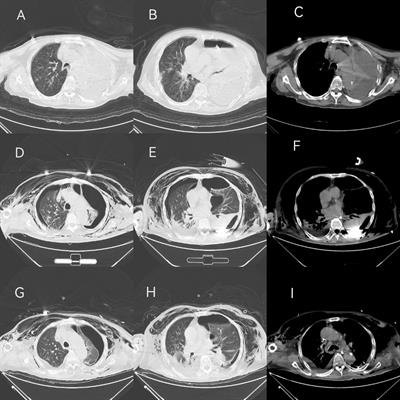 Severe pneumonia with empyema due to multiple anaerobic infections: case report and literature review